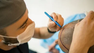 Hair Transplant in Dubai