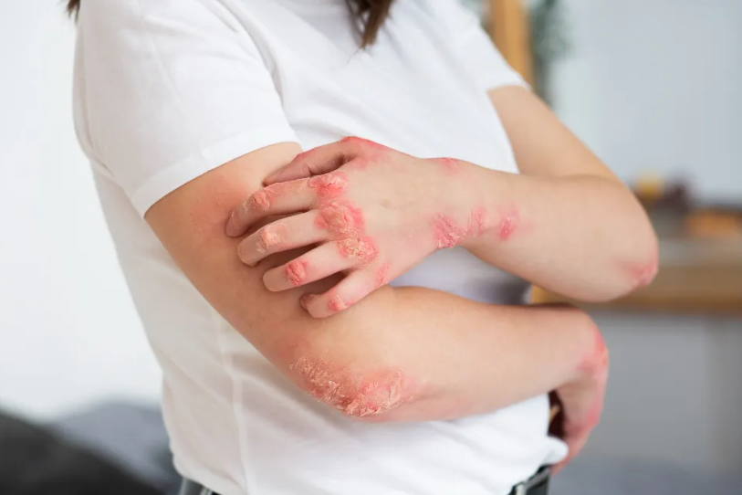 How Does Ayurveda Reduce Skin Allergy by Healing Internally?